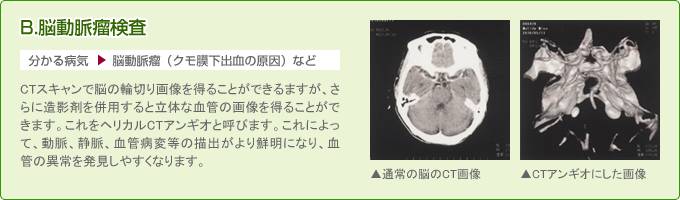 CTアンギオでみる脳腫瘍検査（血管異常の発見）